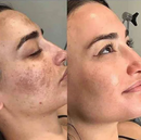 Clareador de Manchas e Anti-Sinais de idade