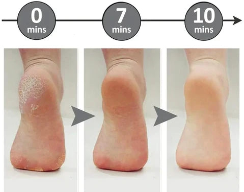 Removedor de Calos e Rachaduras